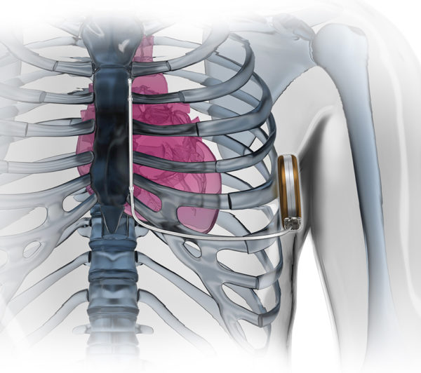 EMBLEM™ - MRI S-ICD System
