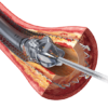 JETSTREAM_ISR Jetstream™ - Atherectomy System
