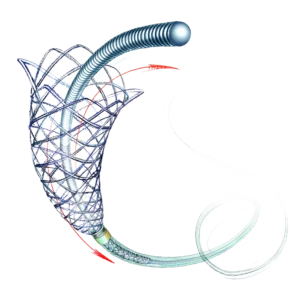 LEO+- Self-Expandable Braided Stent