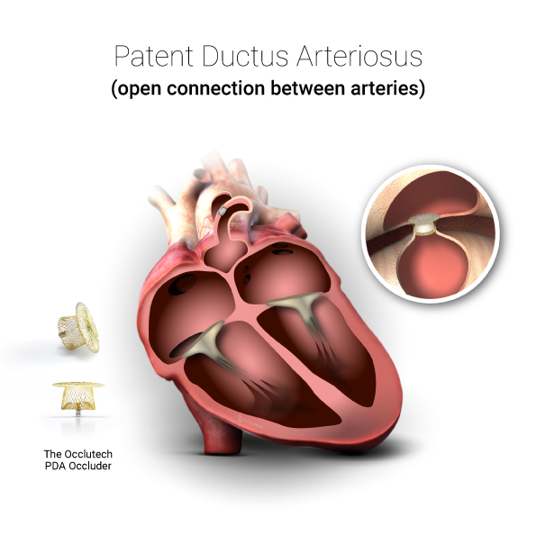 Occlutech_Illustrations_pda-1 Occlutech PDA Occluder
