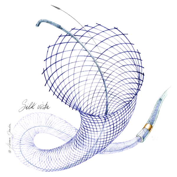 Silk Vista - Flow Diverter