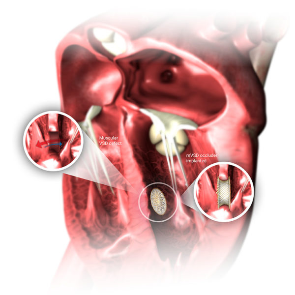 Occlutech mVSD Occluder​